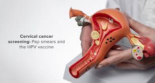 Cervical Cancer Screening
